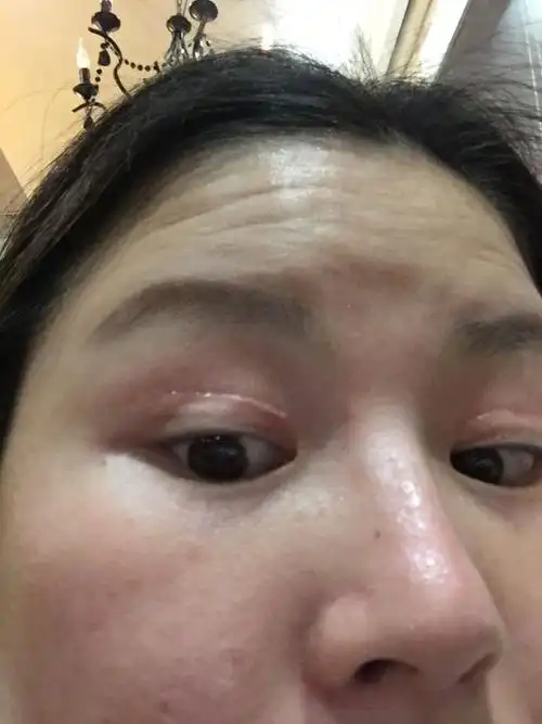 切双眼皮疤痕增生了什麼办?