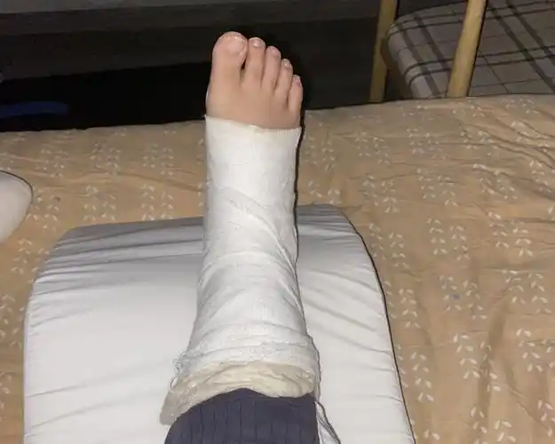 蹦过头了诸暨刘畊宏女孩成石膏拐杖女孩