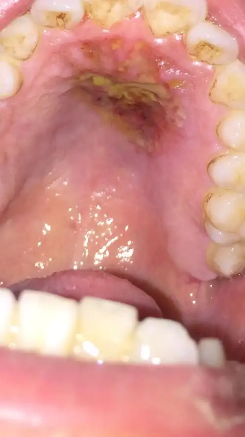 口腔缺血会不会溃疡烂掉,牙龈出血,我使劲一吸出好多血,然后过几天