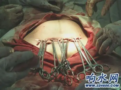 男人们看了你会心酸(剖腹产全过程组图)