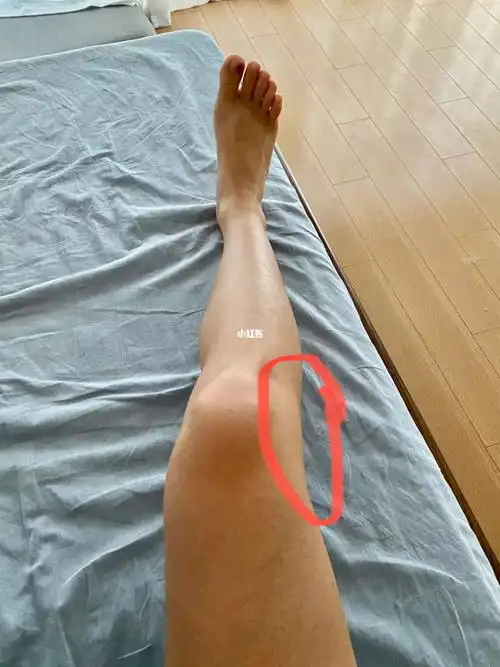 跑完步右膝盖外侧又疼了是髂胫束综合症吗