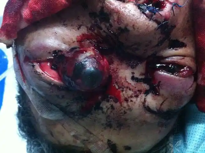 【讨论】这例眼球脱臼,视神经撕脱,若不摘除又会如何?