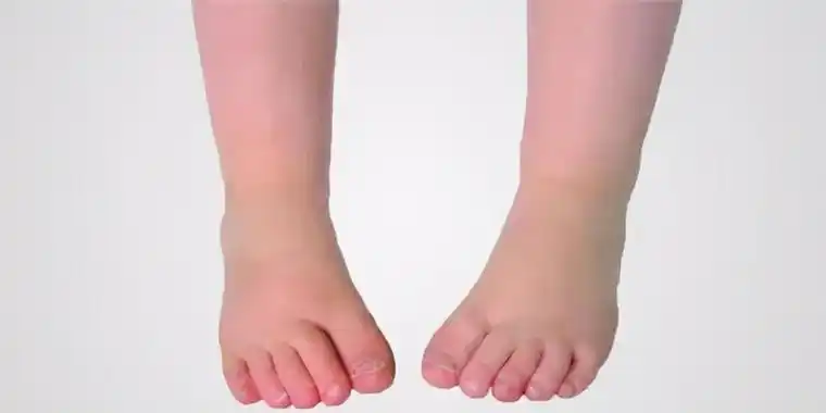 孩子走路内八字怎么回事(孩子走路有点内八字有好方法改变吗) - 天华