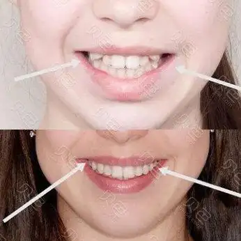 牙齿矫正前后对比效果