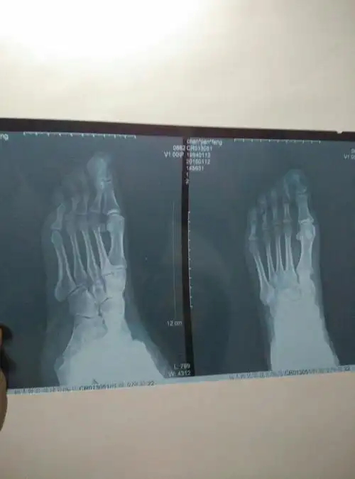 这张脚部ct能看出什么结果?