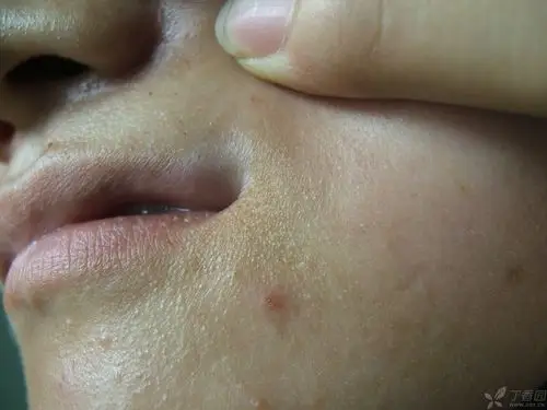【请教】这个女孩烦恼的嘴角白癜风有什么快的好办法