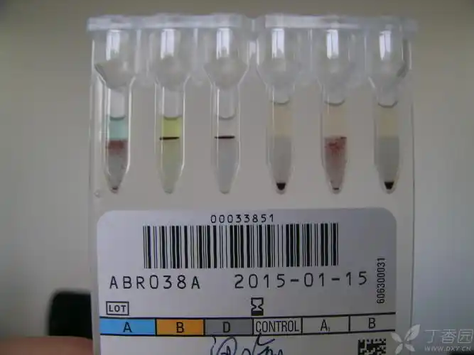 今日门诊一例血型出现定型困难:检测对象为男性,24岁,非患者,为自愿