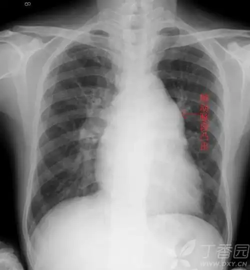 普大型心梨形心靴形心的片子究竟怎么看啊丁香园
