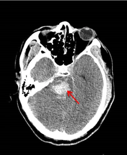 术前颅脑ct可见脑干出血.