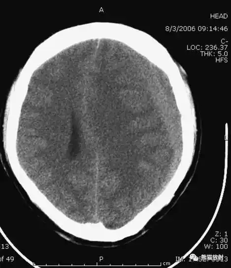 值班必备 | 急诊颅脑ct常见的八种疾病