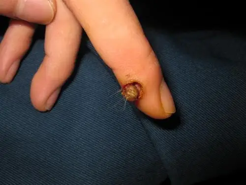 寻常疣连根拔除