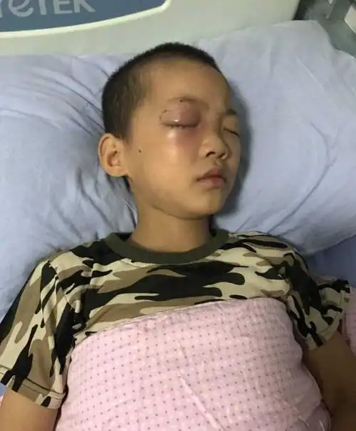 8岁男童眼睛被毁,看似不起眼的东西,却成为身边的"定时炸弹"|干燥剂