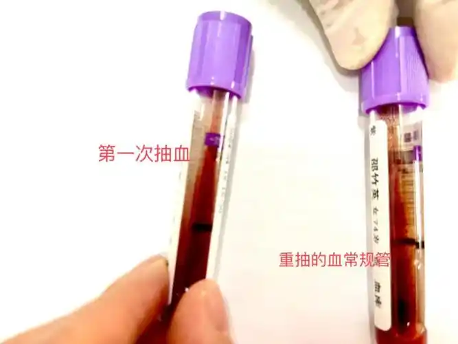 ""血液有小凝块!差点把血型定错"吓了笔者一身冷汗.难道是血液凝集了?