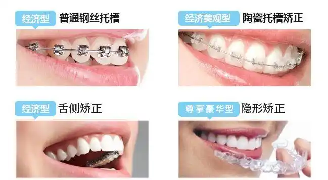 成都牙齿矫正哪里好要多少钱牙齿拥挤不齐戴哪种牙套合适