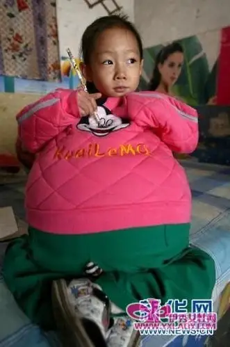 女童肚子大过孕妇赴京治疗续:因暂不宜手术转院