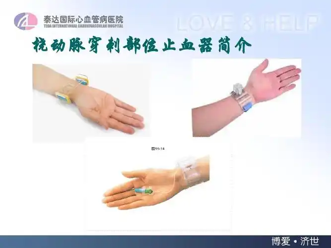 肥胖患者冠脉造影术后应用tr band减压时间的探讨ppt