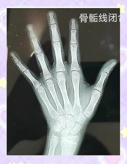 两位粉丝家长提供了两张骨龄片,让我们一起来看看骨骺线闭合前后的