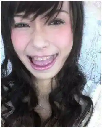 为了变得更美,angelababy选择了整牙.