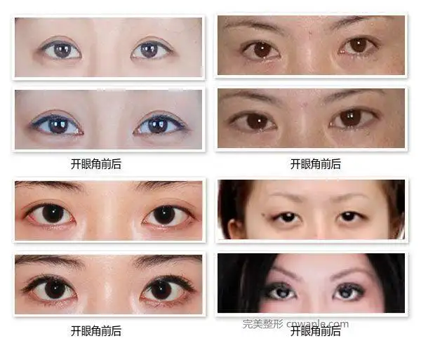 开眼角需要多久的恢复期-完美整形