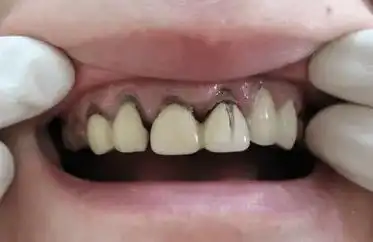 牙齿_基牙_患者