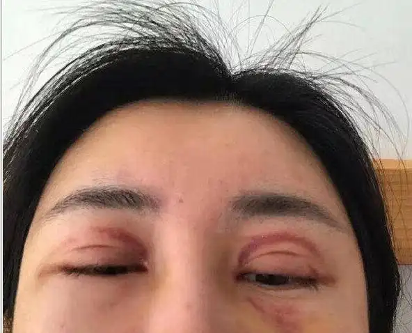 双眼皮失败一年多还是这个样子