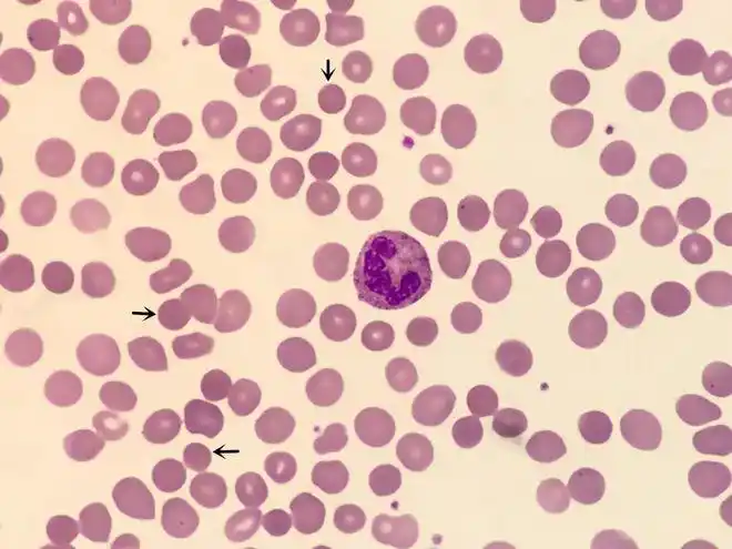 一例新生儿遗传性球形红细胞增多症案例分享