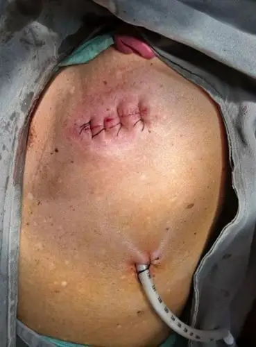 快速发展的新沂市中心医院胸外科