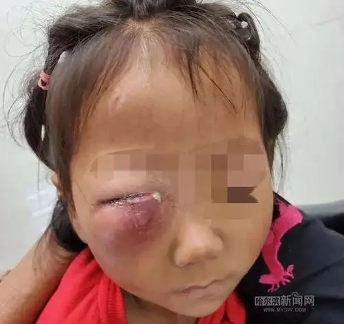 5岁女孩"封眼"入icu,病根竟然因一颗"智齿"!