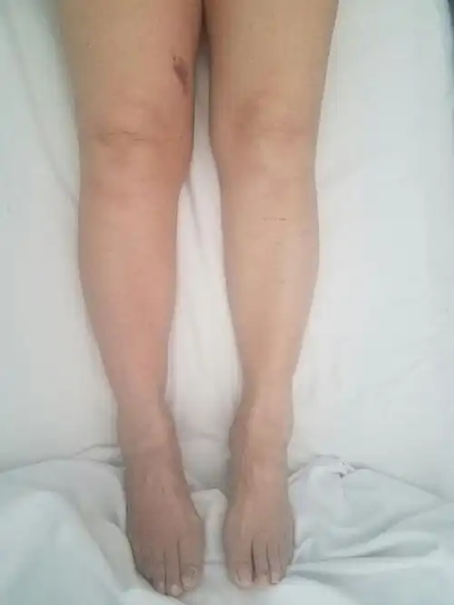 20年的"大象腿"一朝变苗条