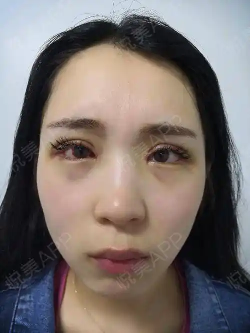 眼部多项术后7天_眼型矫正术后7天_眼部多项术后7天_开眼角术后7天_双
