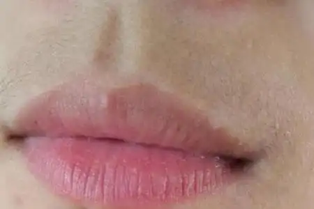女孩子长唇毛要怎么才能彻底去除