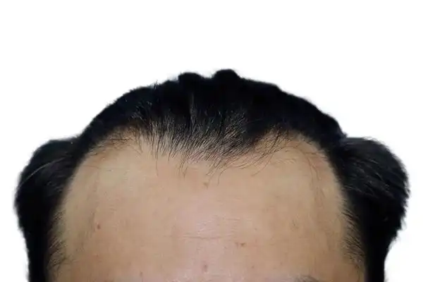 发际线高是什么原因