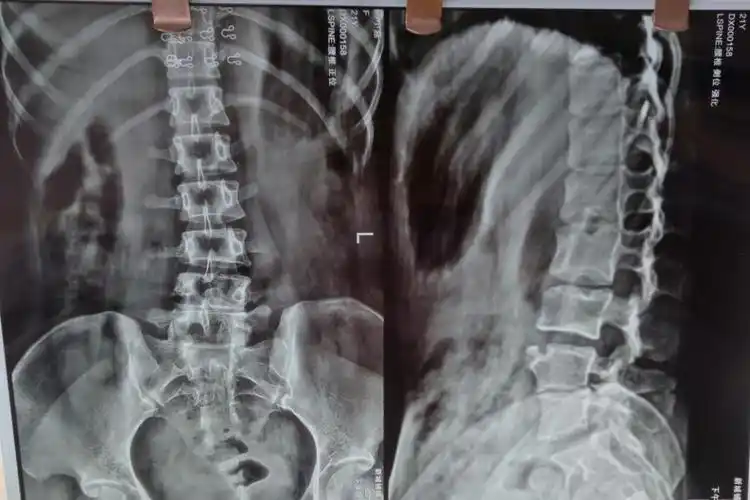 ②腰椎ct(腰椎椎体ct或腰椎间盘ct)