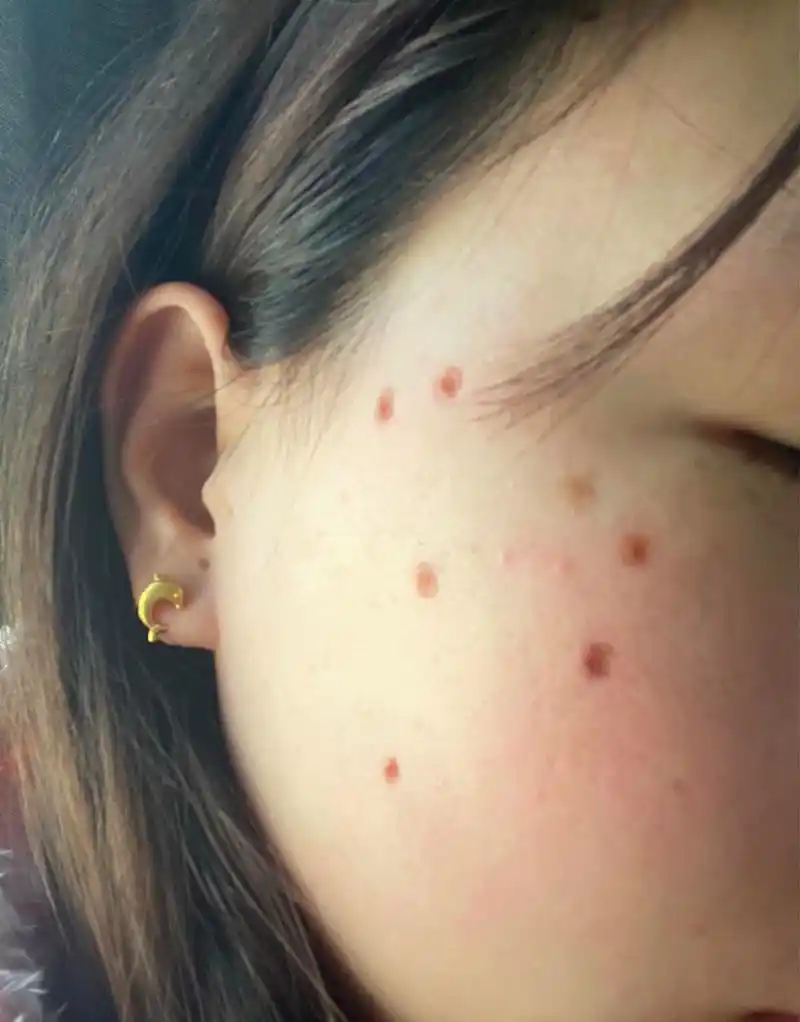 脸上的痣图片及全解  关于脸上的痣,一般人除想到是否美观外,还有就是