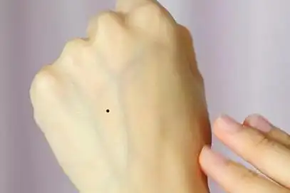 手背上长痣象征什么寓意,手背有痣财运好吗?