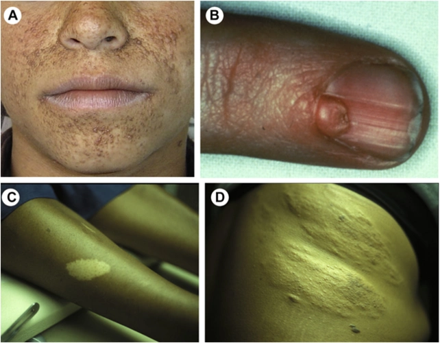 结节性硬化症_介绍_治疗方式 - 好大夫在线