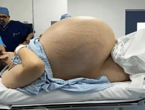 然而羊水过多也会对孕妇及胎儿产生不良影响.