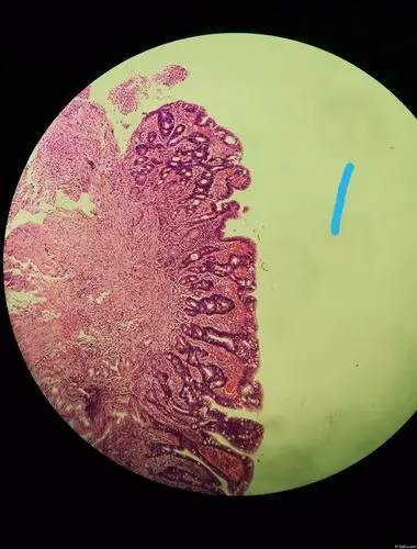 胃角爬行癌讨论病例山东省消化道早癌病理群385