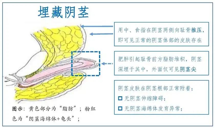 男性生殖器畸形_男性生殖器畸形发病原因 - 好大夫在线