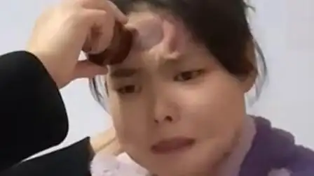 女生头痛,妈妈在其额头拔火罐治疗.