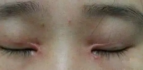 双眼皮疤痕增生是什么样子的