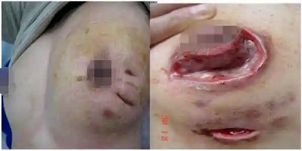 瘘管型浆细胞性乳腺炎,多由早期延误治疗或治疗不当,由脓肿形转化而成