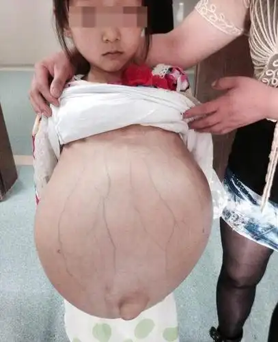 10岁女孩饭量大增身材走样,医生检查后大吃一惊!