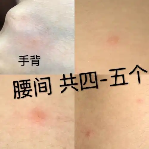 请问这是被什么咬了呢?跳蚤还是螨虫