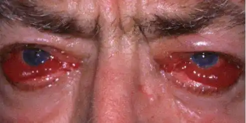 华西论健 | 眼睛又突又大 警惕是你有病