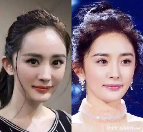 明星植发前后图片是怎样的?植发后的注意事项有哪些?