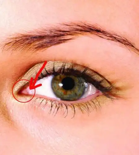 开内眼角前后对比图