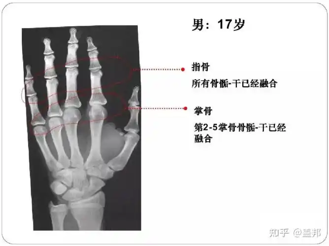 骨龄几岁还能长高吗男孩篇