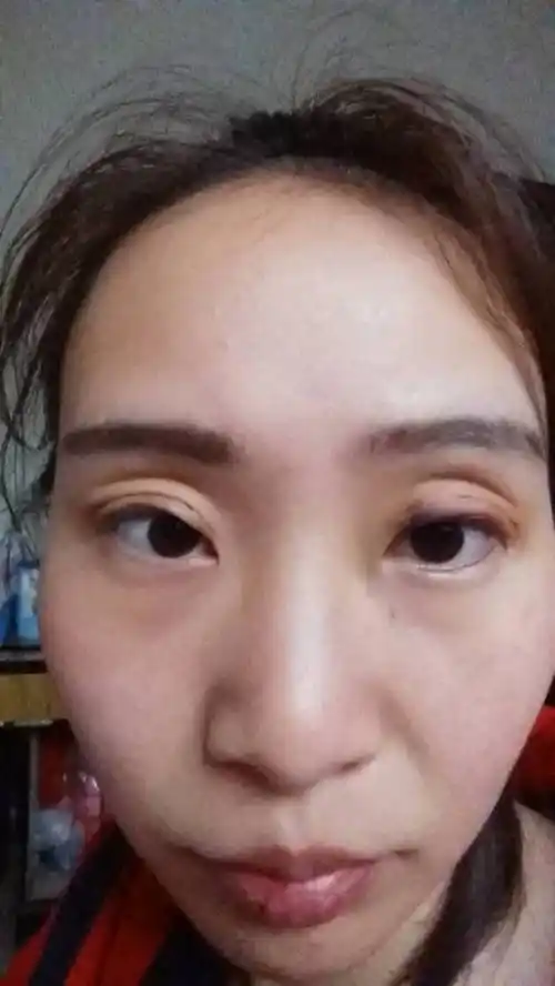 我埋线做双眼皮今天第五天了,一个眼睛觉得没有双眼皮一样的?