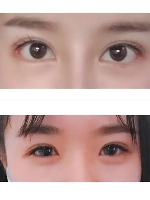 开外眼角一定会回缩吗?